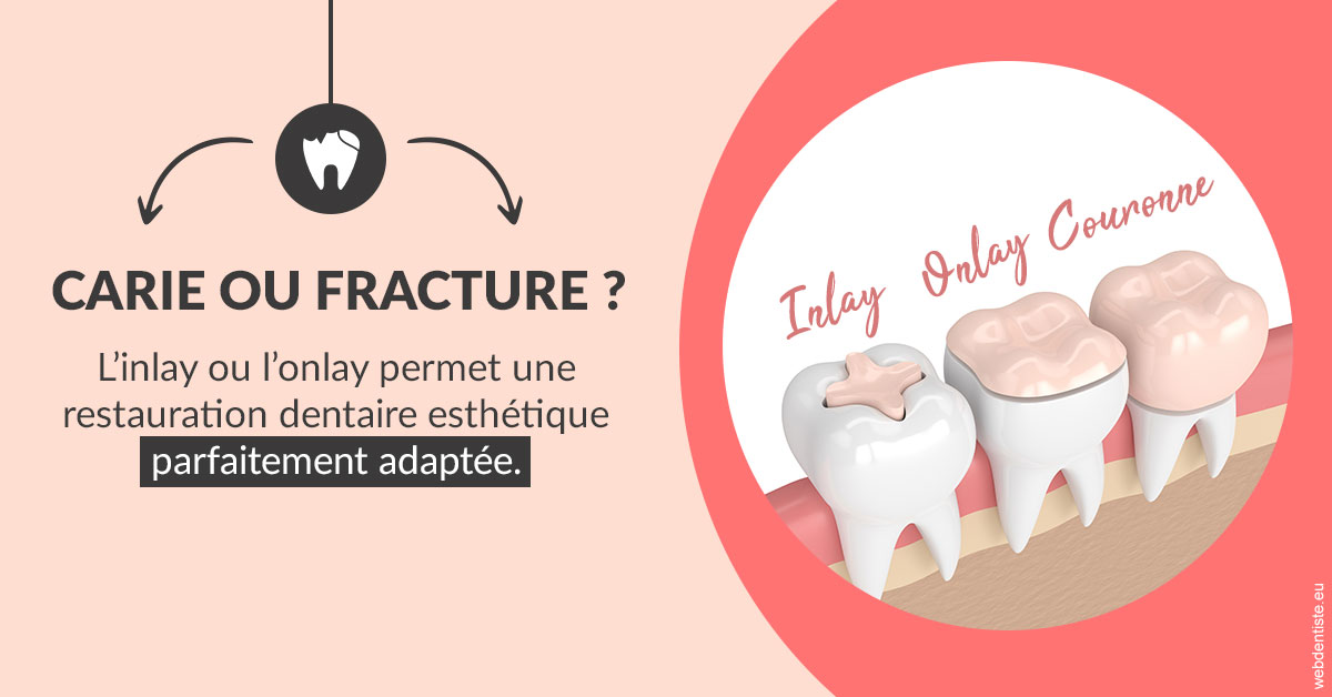 https://dr-sanglard-gilles.chirurgiens-dentistes.fr/T2 2023 - Carie ou fracture 2
