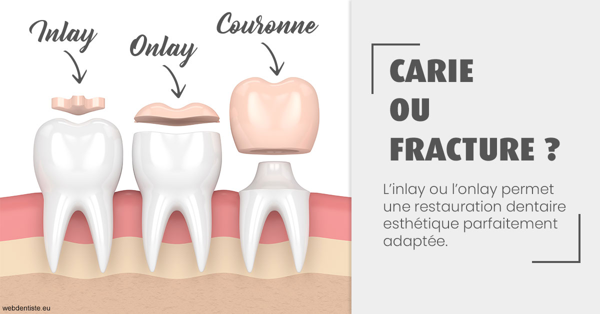 https://dr-sanglard-gilles.chirurgiens-dentistes.fr/T2 2023 - Carie ou fracture 1