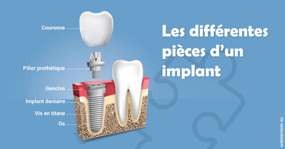 https://dr-sanglard-gilles.chirurgiens-dentistes.fr/Les différentes pièces d’un implant 1